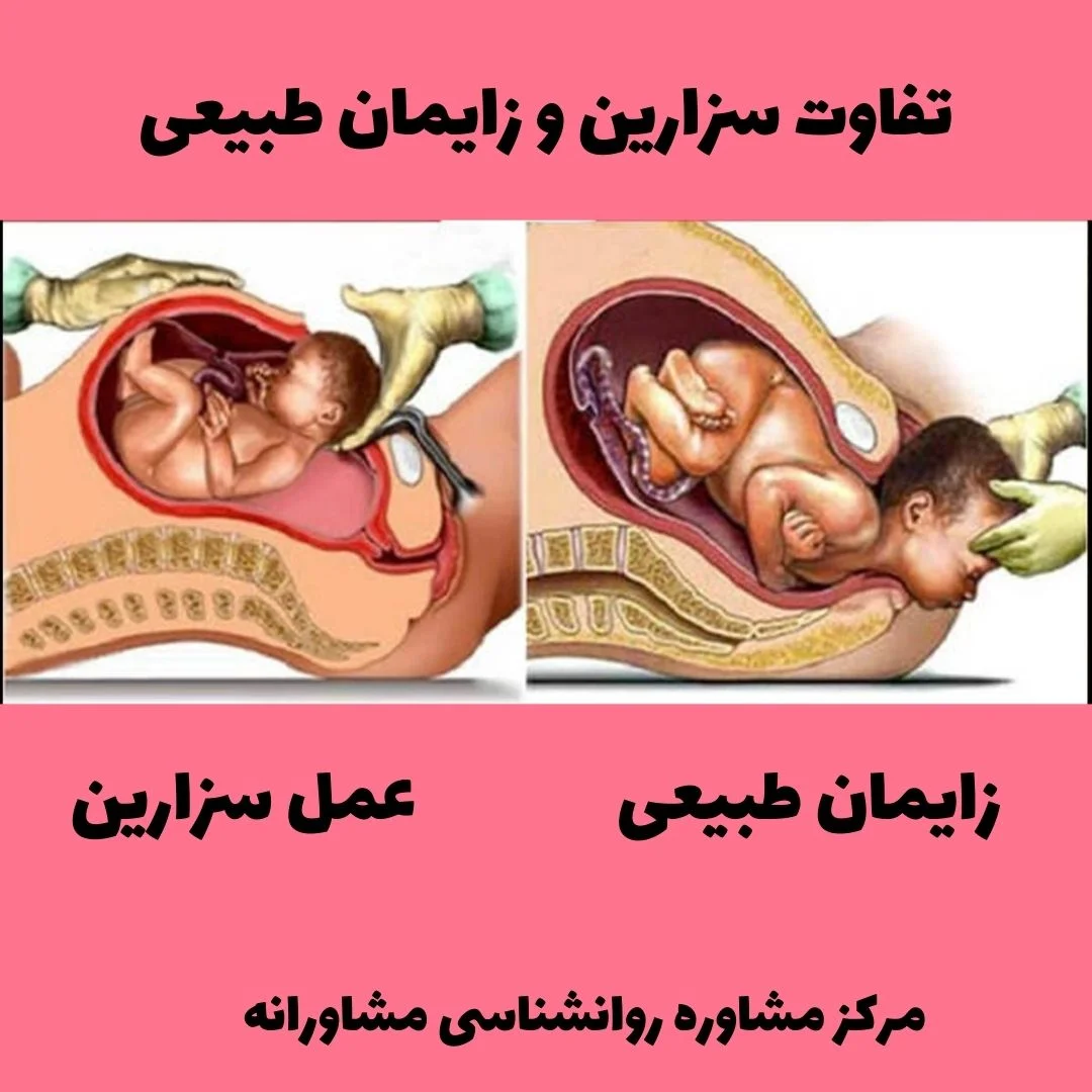 مقایسه سزارین و زایمان طبیعی