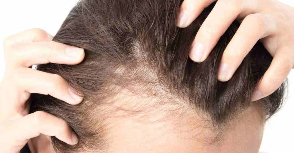 ریزش مو ، علل و درمان های خانگی برای ریزش مو